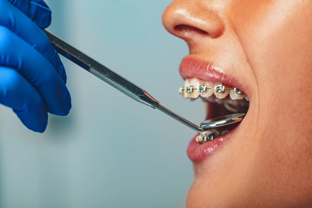 Aparat stały czy nakładkowy – Co lepiej wybrać?