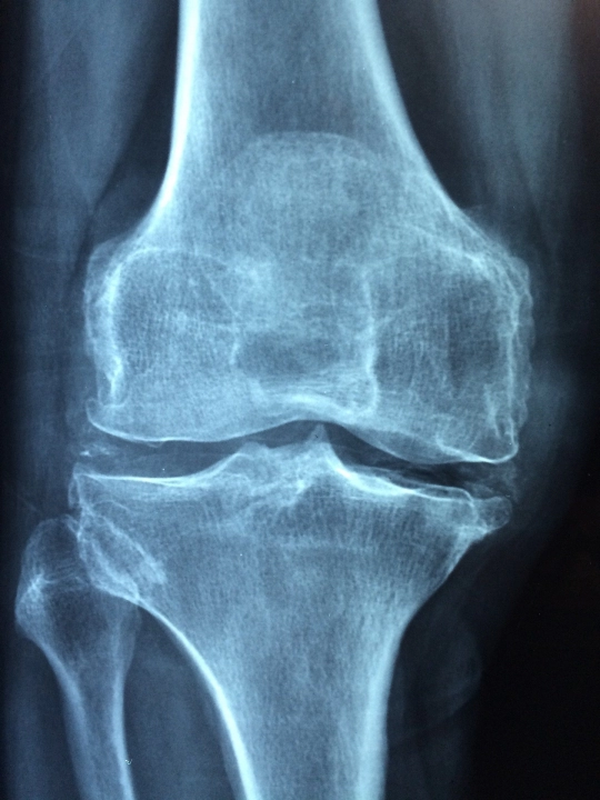 Środa z profilaktyką: osteoporoza