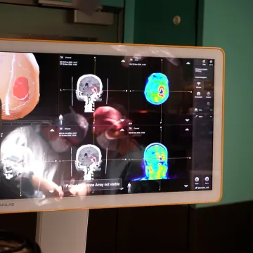 Pierwsza taka operacja w Polsce. Przełom w leczeniu glejaka w Łodzi