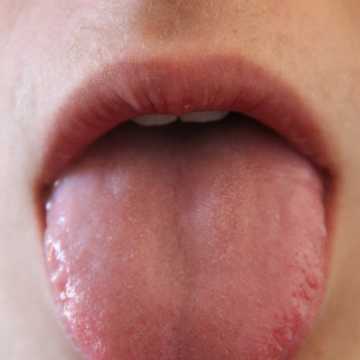 Piecze język? To może być nowotwór głowy i szyi. Kolejna Środa z profilaktyką