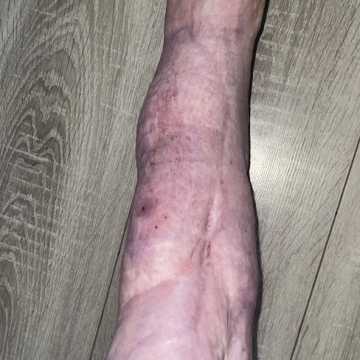 Zbiórka na operację zmiażdżonej nogi Oliwiera po wypadku w parku rozrywki